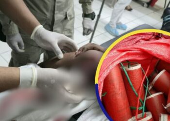 ¡Lamentable! Pólvora sigue marcando de por vida a menores hondureños esta Navidad