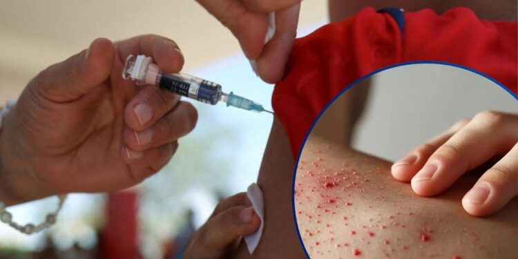 OPS alerta por fuerte aumento de casos de sarampión en las Américas