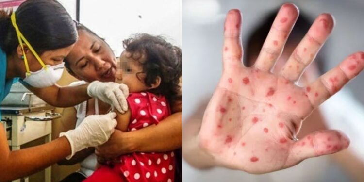 Perú brote de sarampión emergencia