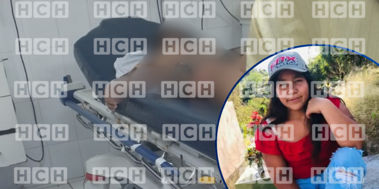 ¡Escalofriante! Fallece una mujer embarazada que sufrió graves quemaduras en Copán