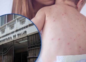 ¡El primer menor! Sesal confirma un nuevo caso de sarampión, se trata de un bebé de 6 meses