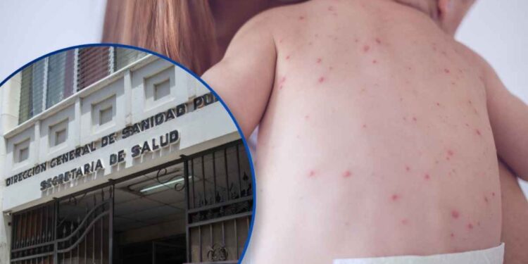 ¡El primer menor! Sesal confirma un nuevo caso de sarampión, se trata de un bebé de 6 meses